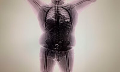 Un hombre fue detenido en Argentina al descubrir que llevaba cocaína en cápsulas dentro del estómago; una estaba a punto de explotar.