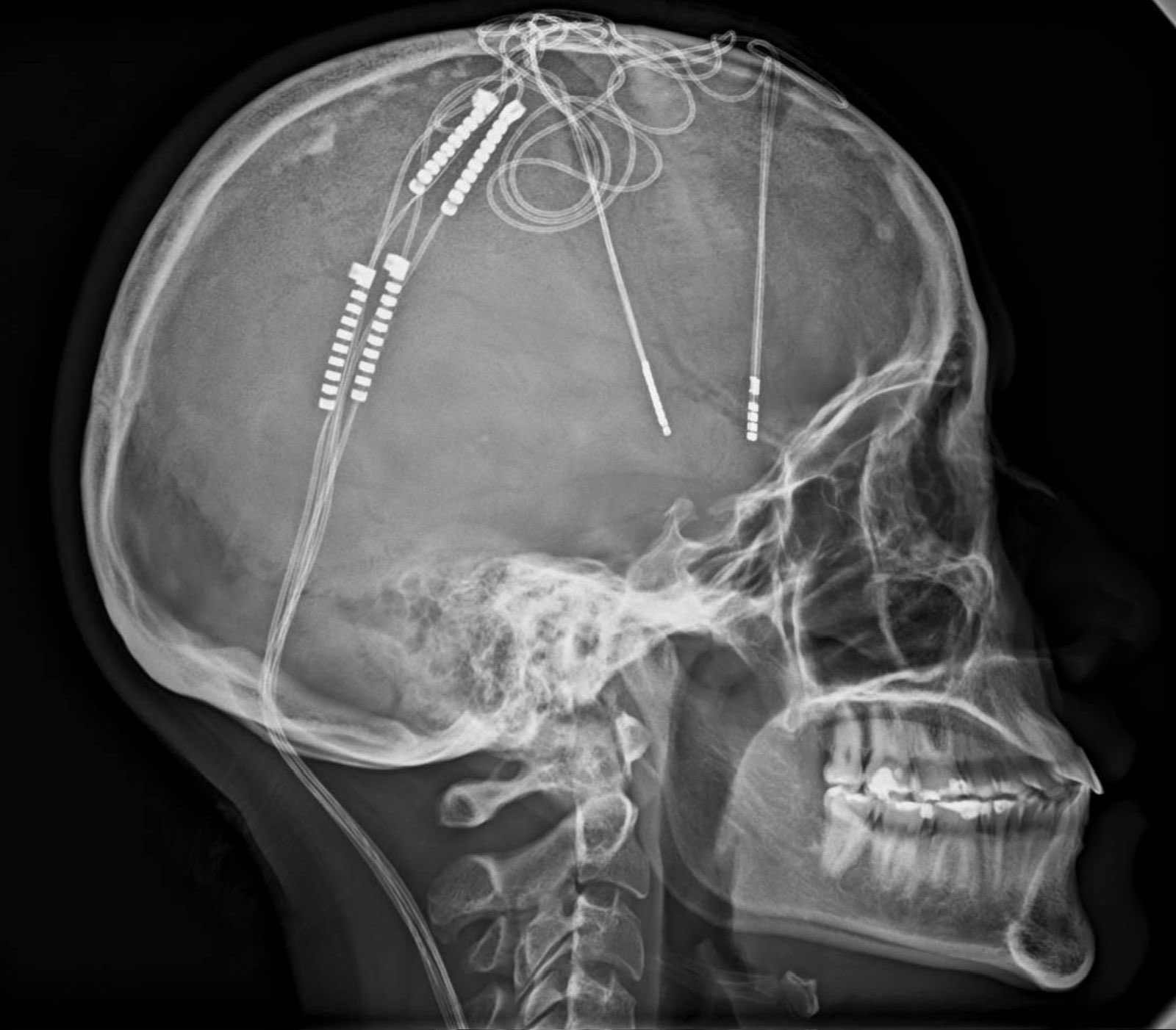 Lorena Rodríguez es la primera colombiana intervenida con estimulación cerebral profunda para tratar depresión resistente. La noticia conmueve redes sociales.