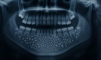 El increíble caso del niño al que le extrajeron 526 dientes en una sola cirugía