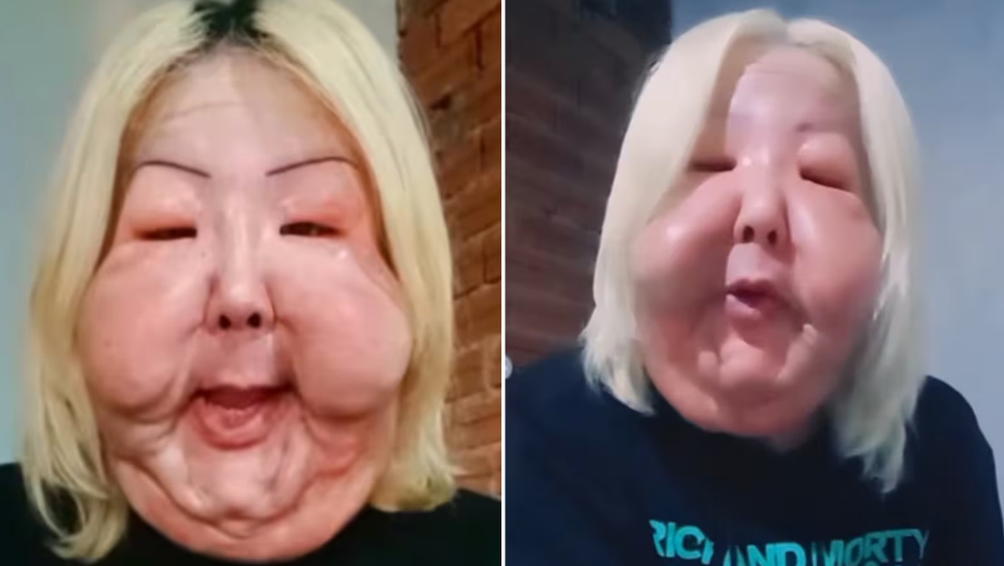 Cirugía busca reparar daño por estética clandestina en Brasil